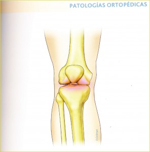 patologias ortopedicas gonartrosis