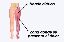 Localización dolor del nervio ciático